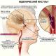 Simptomi i znaci moždanog udara (ishemijski tip) Kliničke manifestacije moždanog udara